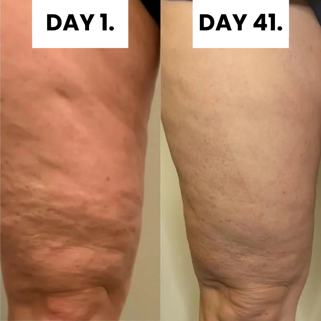 Celluvia™ Cellulite Relief Kit